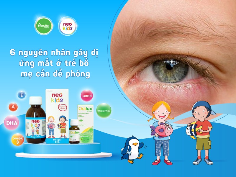 6 nguyên nhân gây dị ứng mắt ở trẻ bố mẹ cần đề phòng