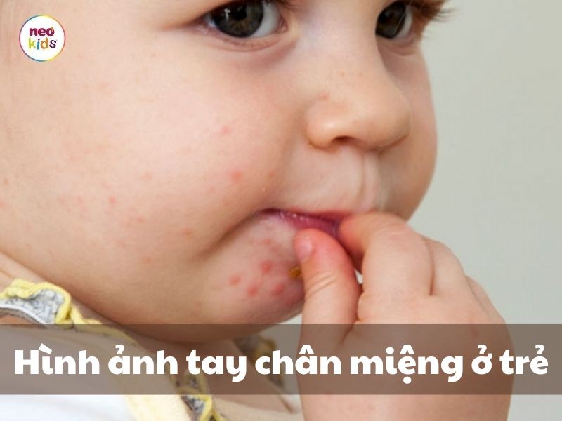 Hình ảnh bệnh tay chân miệng ở trẻ em - dấu hiệu nhận diện và phân biệt