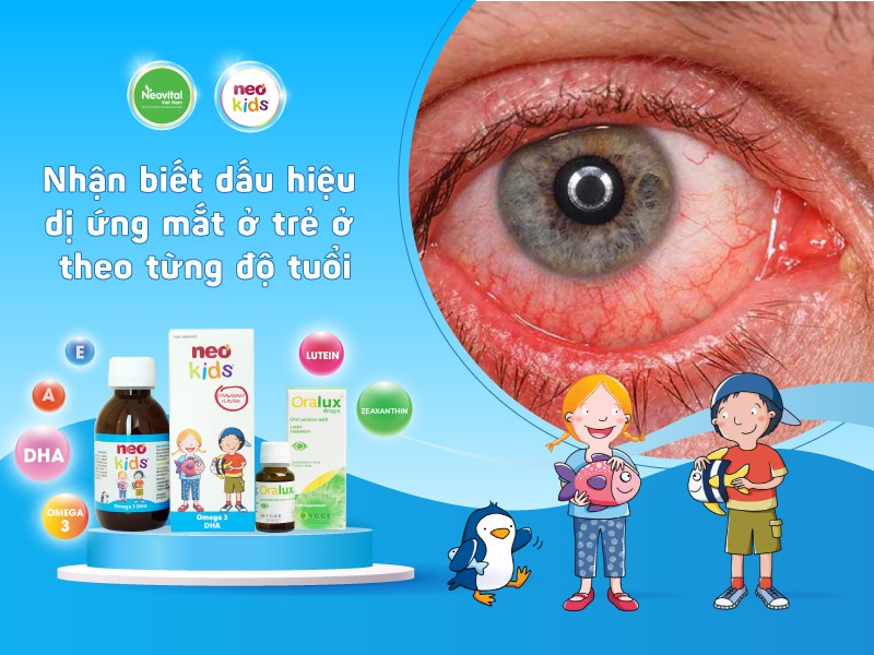 Nhận biết dấu hiệu dị ứng mắt ở trẻ ở theo từng độ tuổi